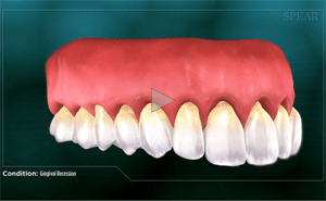 Gums with receding condition, exposing the tooth roots. Light yellow teeth, red gums.