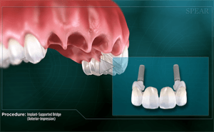 Anatomy of a dental implant-supported bridge in place and in isolation, on a turquoise background.