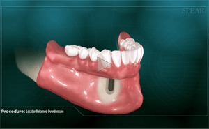 Diagram of a dental implant in a jawbone with a denture secured to it.