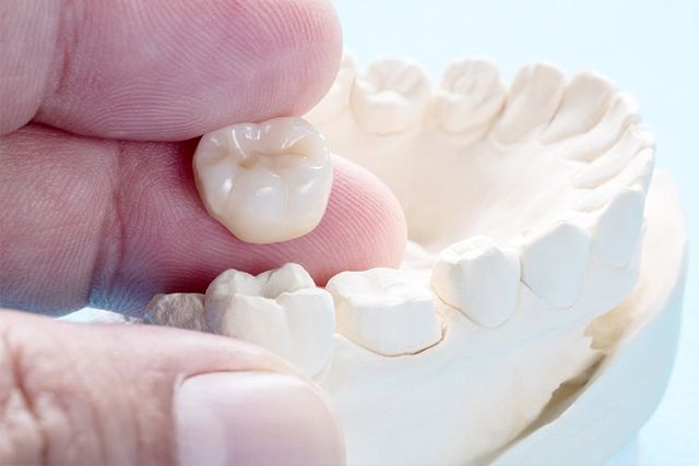 Durability of Porcelain Crowns in Vietnam: How Long Do Permanent Crowns Really Last? 3 Why Porcelain Crowns in Vietnam Are Built to Last