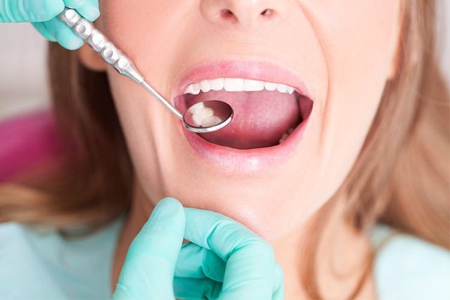 4 Ways to Avoid Getting a Dental Filling - Georgetown Dental Partners  Georgetown Massachusetts
