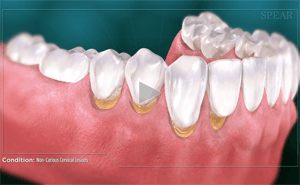 Dental illustration showing non-carious cervical lesions, with yellowing near the gum line on some teeth.
