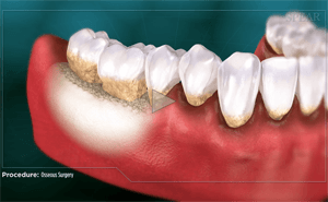 Animation of teeth in a red gum, showing bone loss with a highlighted area, for a procedure called bone surgery.