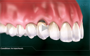 Animated depiction of a front tooth missing, gum inflamed.  Text: Failed Implant Results.