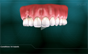 Dental model showing a missing tooth and peri-implantitis (inflammation).