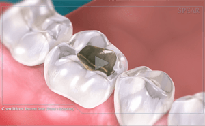 3D animation of teeth. A molar with a silver filling next to healthy teeth.