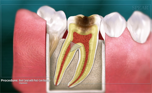 Cross-section of a tooth showing root canal treatment; decayed area and filling in yellow, red, and white.