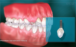 Dental implant illustration: A single implant placed, highlighted by adjacent tooth structure and inset of implant components.