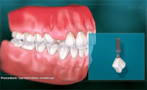 Diagram of dental implant procedure: a tooth, jaw, and implant pieces.