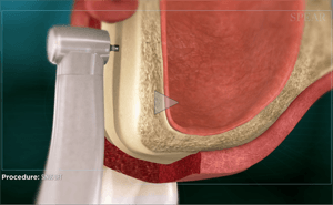 Cross-section of mouth with a dental drill tool. Red and white layers shown in a medical illustration.