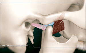 Diagram of the jaw joint, highlighting muscles and bone in shades of tan, pink, and red.