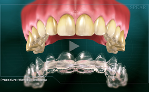Teeth with yellowed enamel above a clear aligner. Demonstrates a dental procedure.