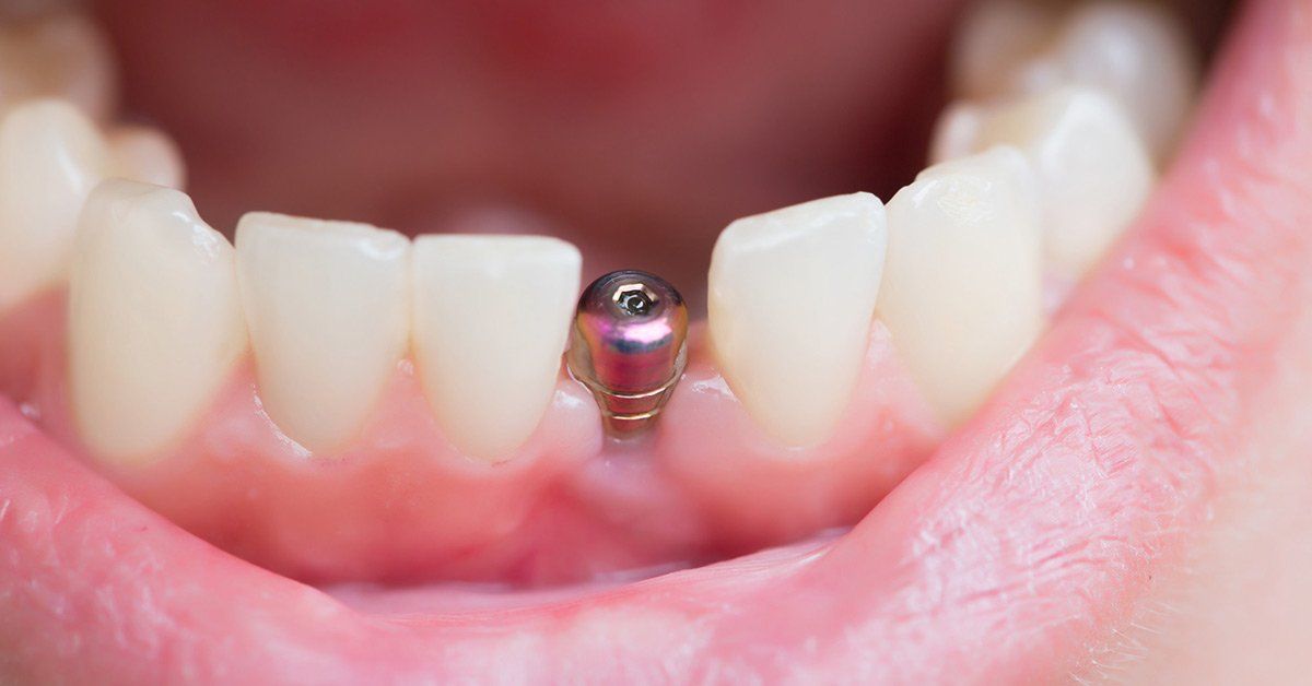 dental implant problems years later