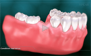 Illustration of teeth with severe tooth infection on a gum line.