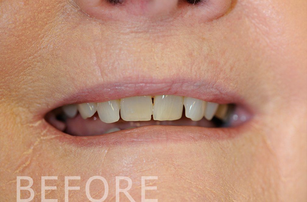 composite veneers before