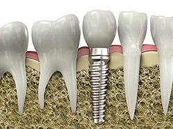 A computer-generated image of a dental implant in a row of teeth