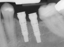 An x-ray of a person's teeth with two dental implants in them