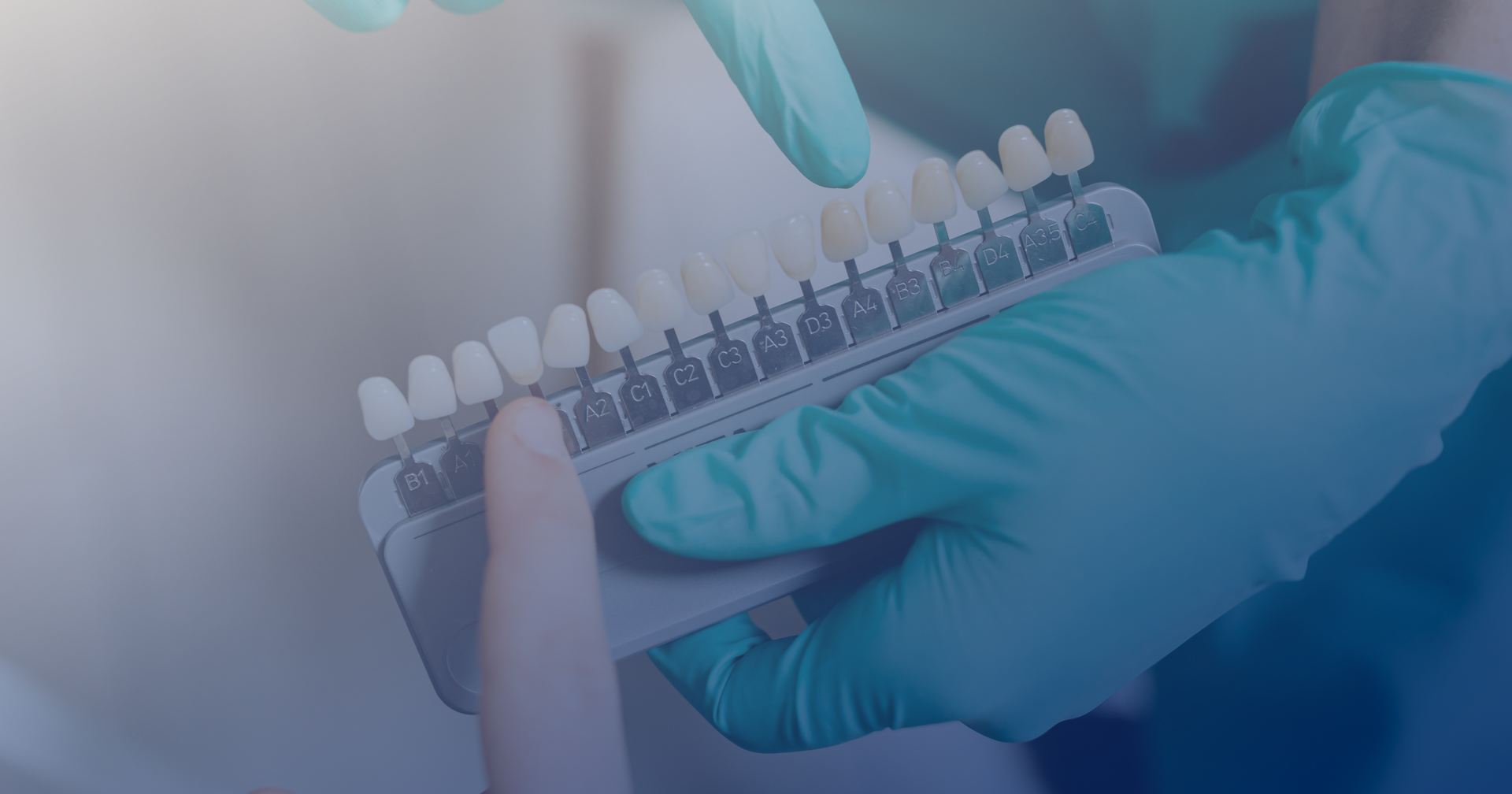 Shade Matching in Dental Restorations with Modern Methods Dental Lab