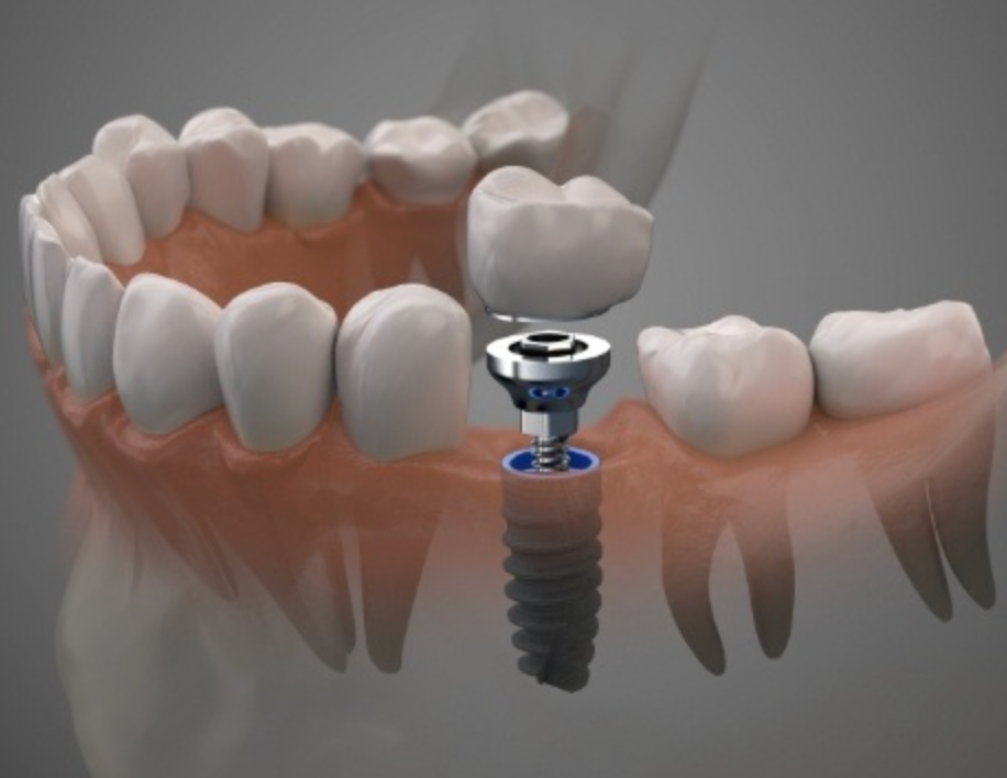 Dental Implants Wichita KS