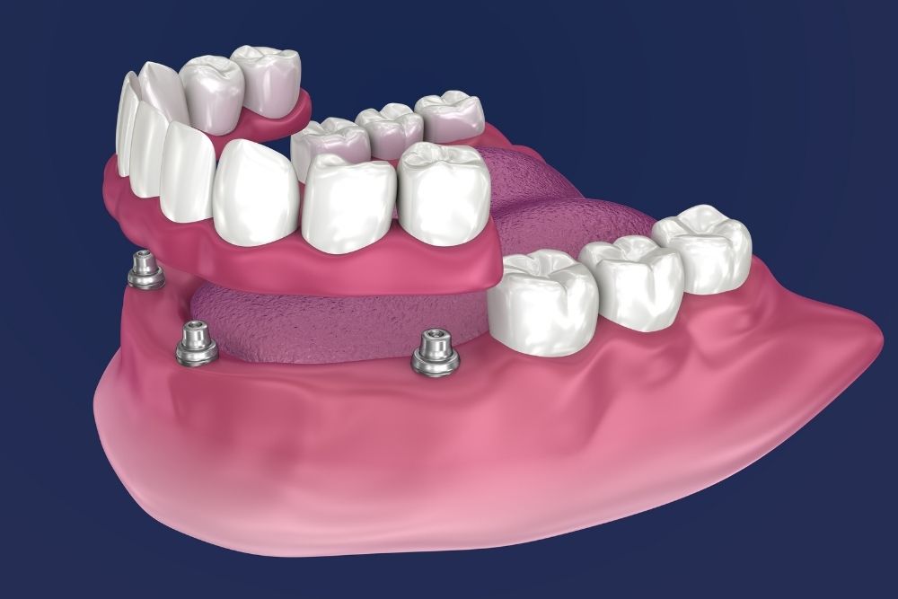 A dental model showing teeth implants with a gum and teeth structure.