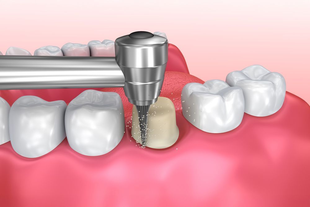 Dental tool drilling into a prepared tooth, surrounded by other teeth and pink gums.