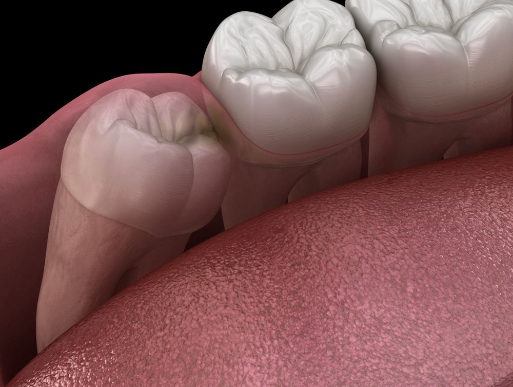 Close-up view of gums and teeth, showing a molar with decay and surrounding healthy teeth.