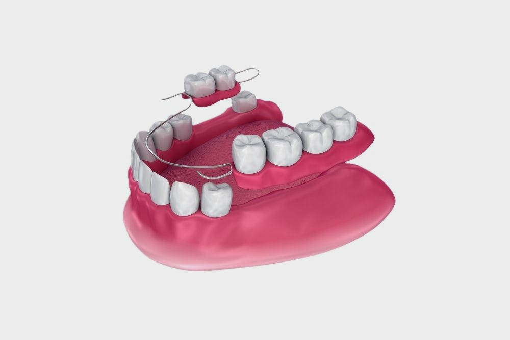 3D rendering of a set of teeth with a dental retainer, showing pink gums, and white teeth.