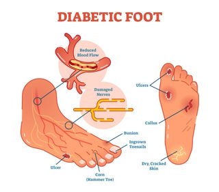 Treatment for Broken Ankle — Diabetic Foot in Derry, NH