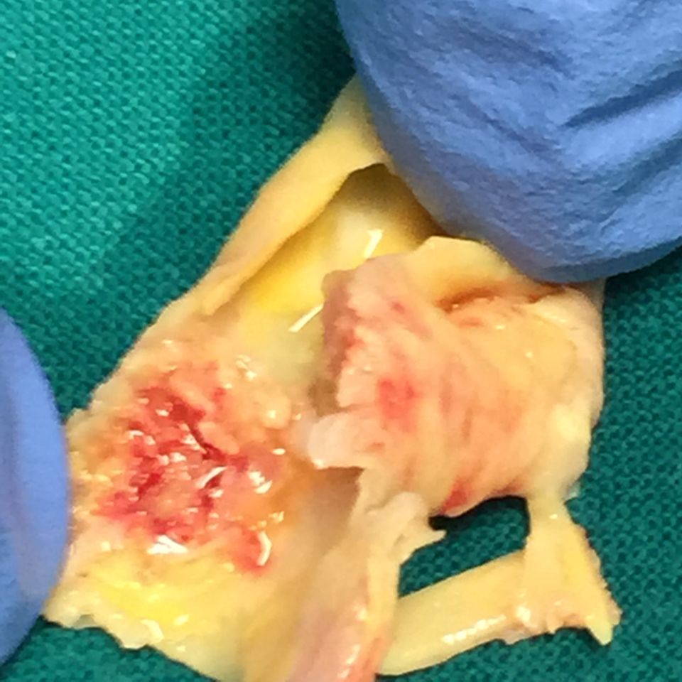 intervento di chirurgia cardiovascolare