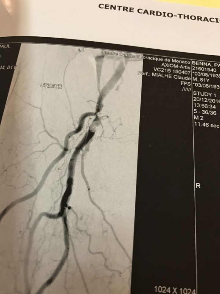 dettaglio arterie prima di un intervento