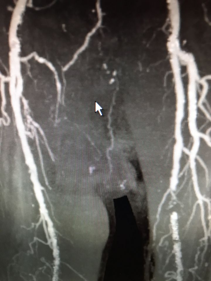 vista arterie prima di un intervento