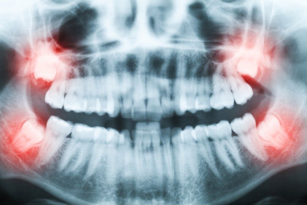 Wisdom Teeth X-Ray — Hermitage Dental in Port Macquarie, NSW