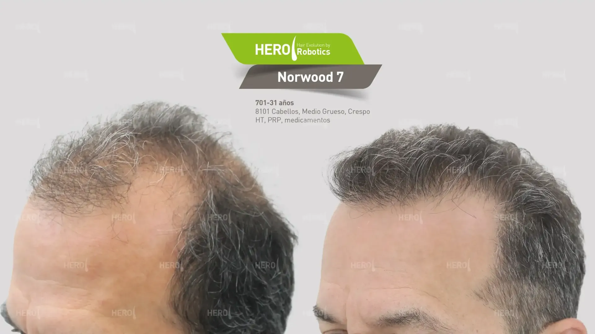 antes y después de trasplante capilar  hombre con alopecia Norwood 7