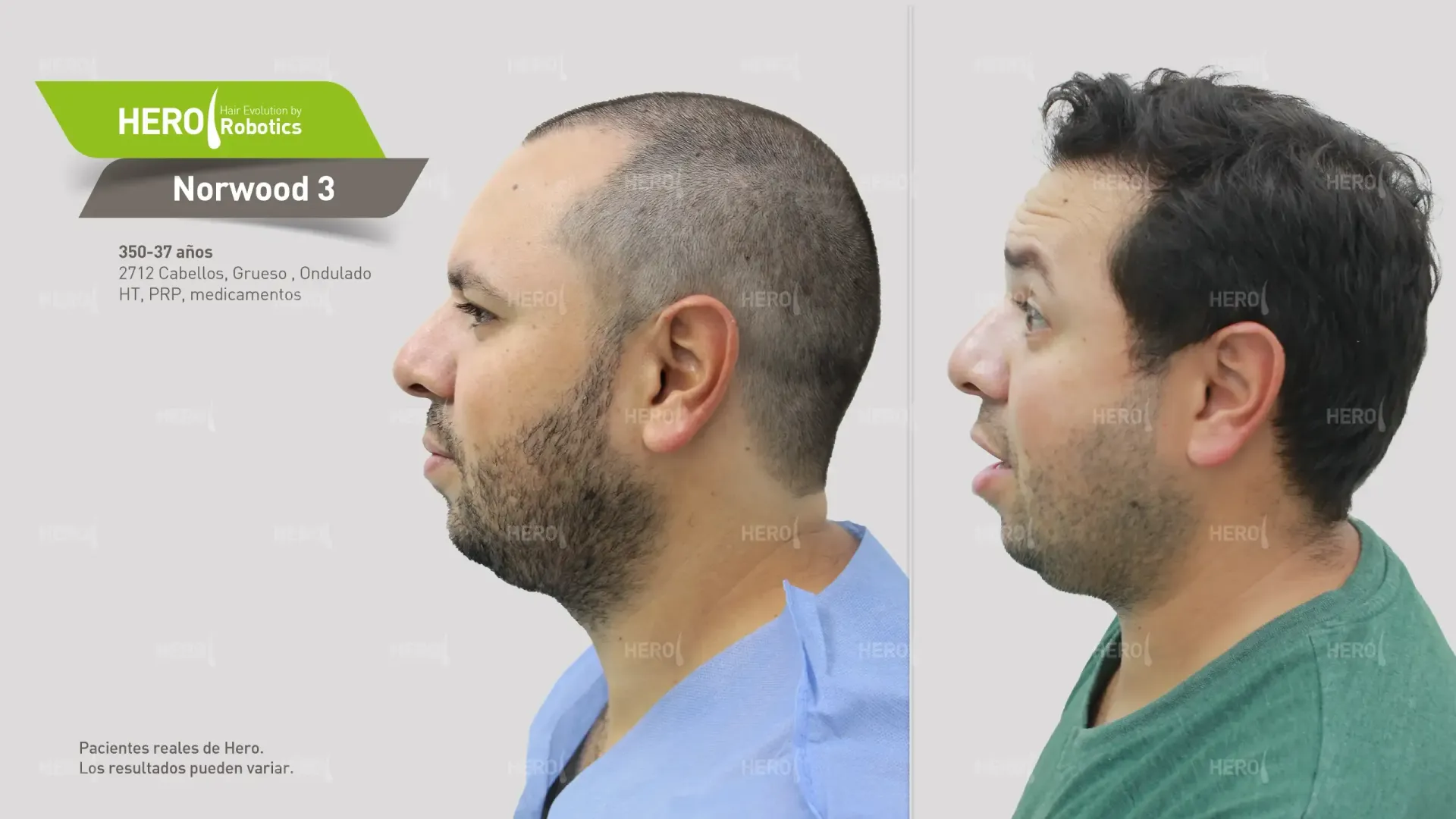A man with a beard is shown in a before and after photo.