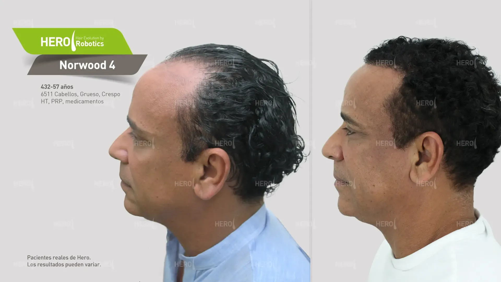 Una fotografía de antes y después del crecimiento del cabello de un hombre Norwood 4.