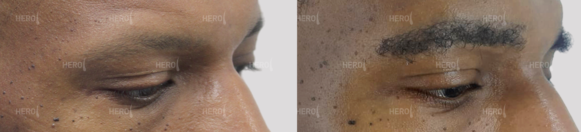 Two close-up views of a person's eyes and brow; the second has darker, fuller eyebrows.