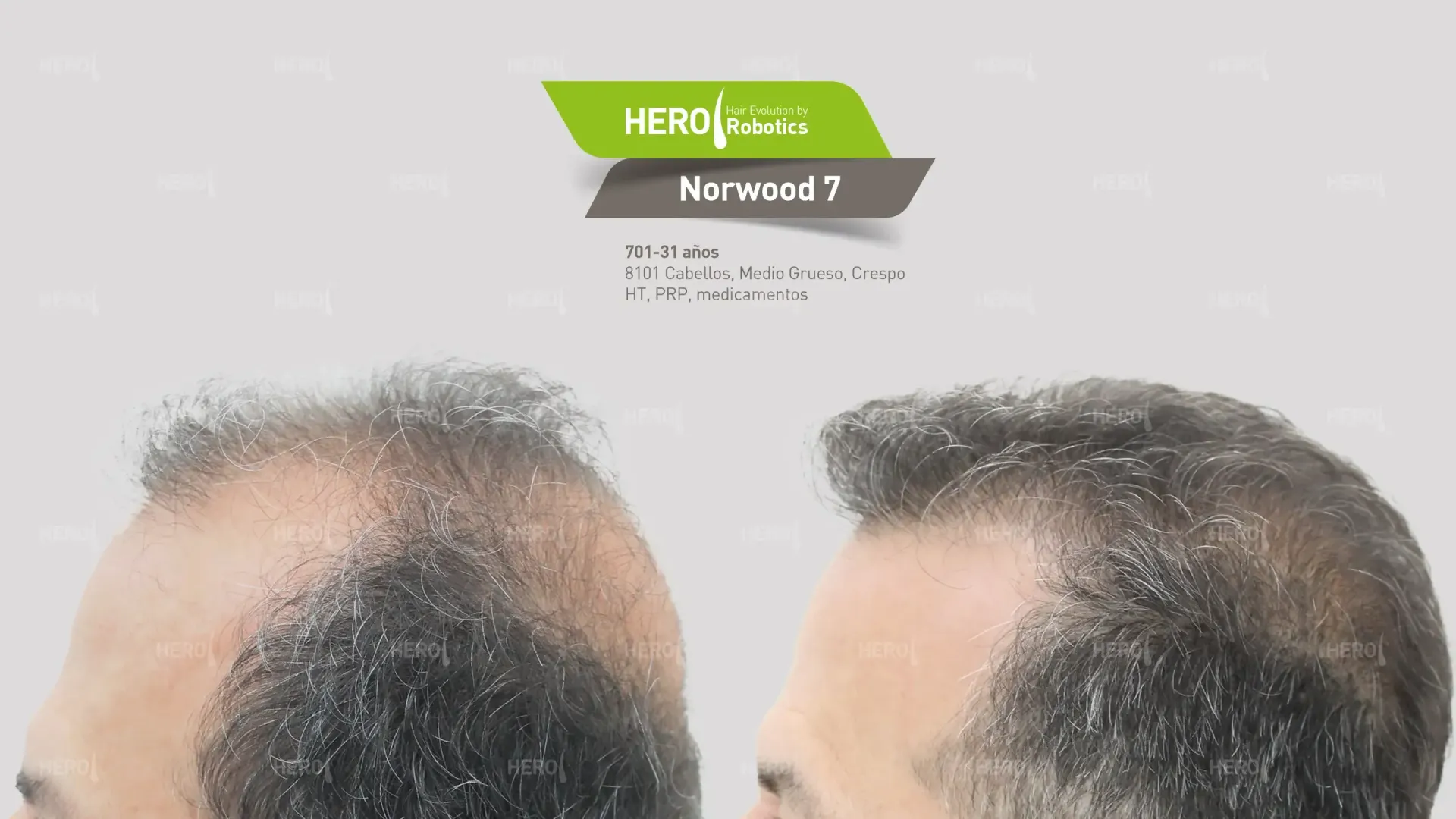 A man 's head is shown before and after a hair transplant.