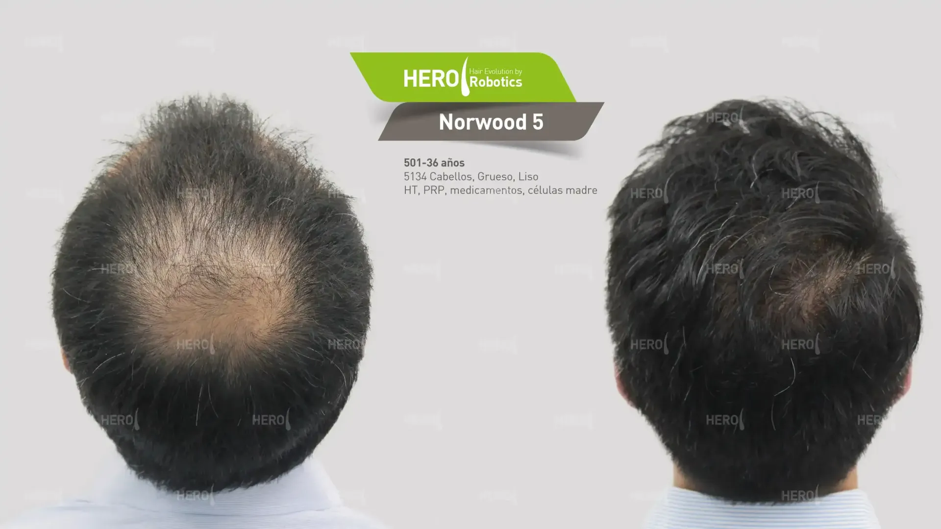 Se muestra la cabeza de un hombre antes y después de un trasplante de cabello.