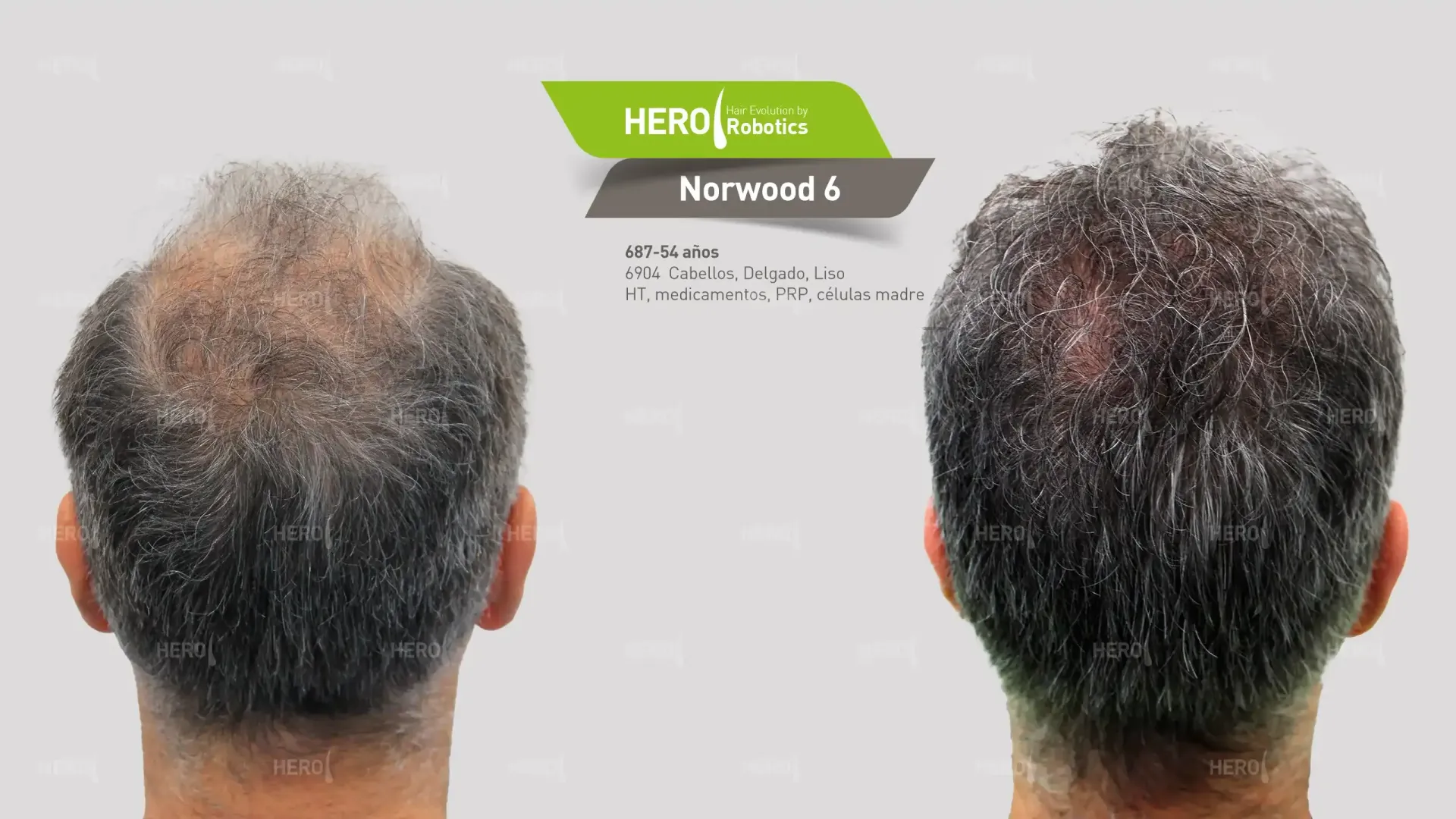 Se muestra la cabeza de un hombre antes y después de un trasplante de cabello.