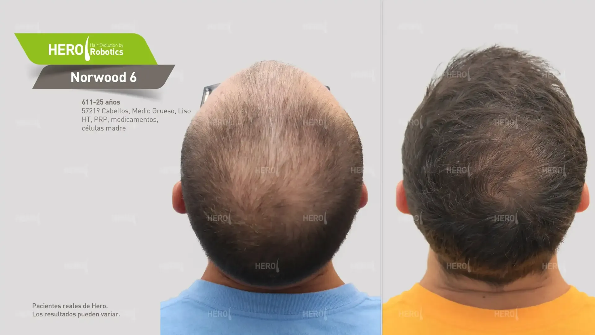 Se muestra la cabeza de un hombre antes y después de un trasplante de cabello.