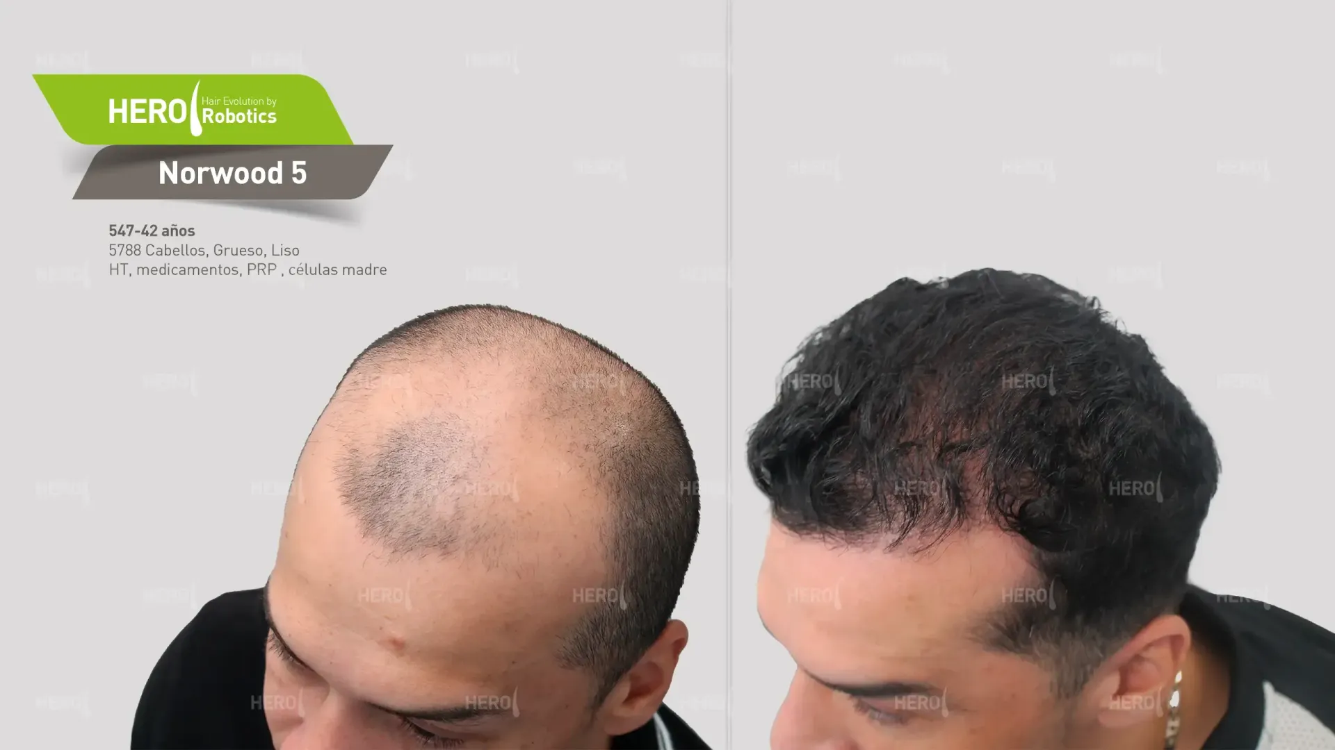 A before and after photo of a man 's hair