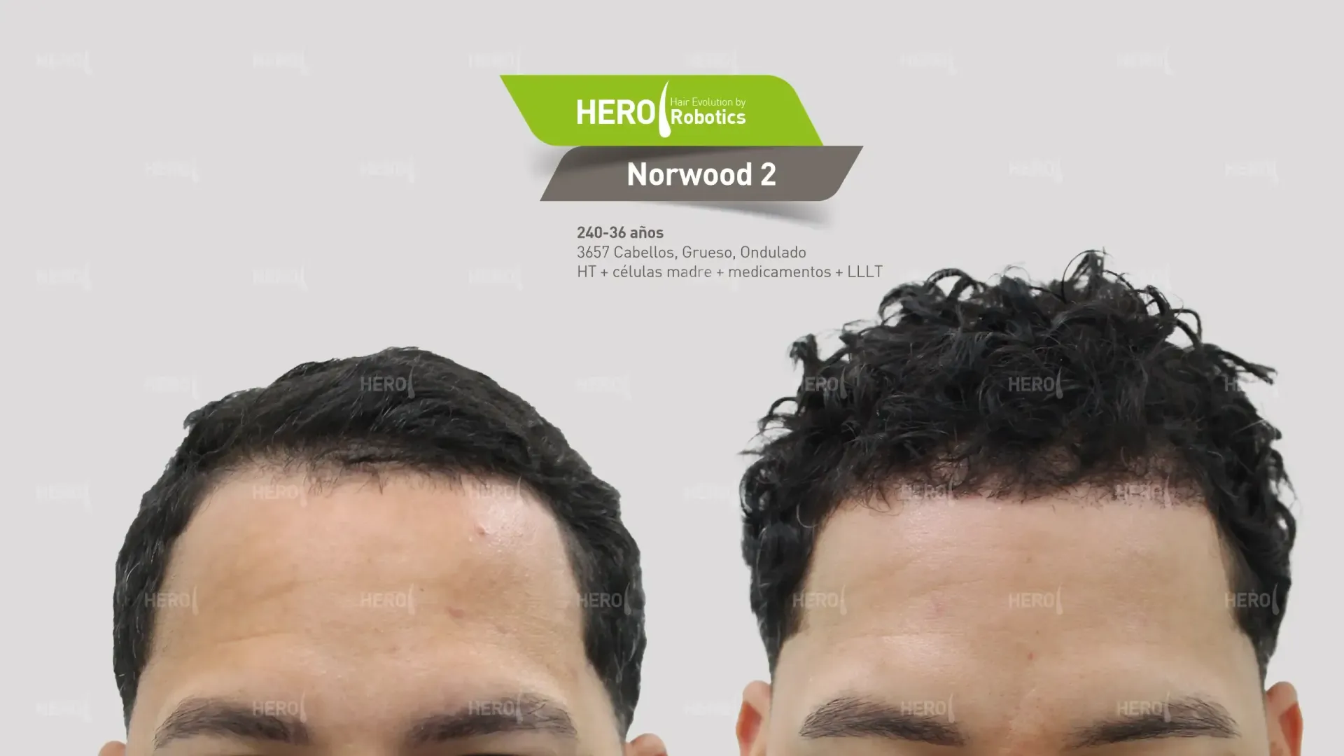 Una foto de antes y después del cabello de un hombre Norwood 2.