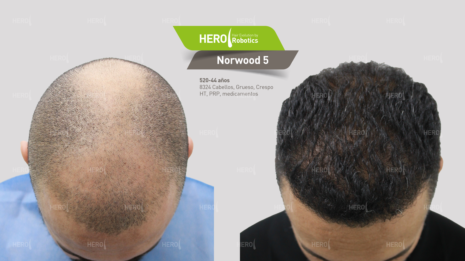 A before and after picture of a man 's hair transplant.