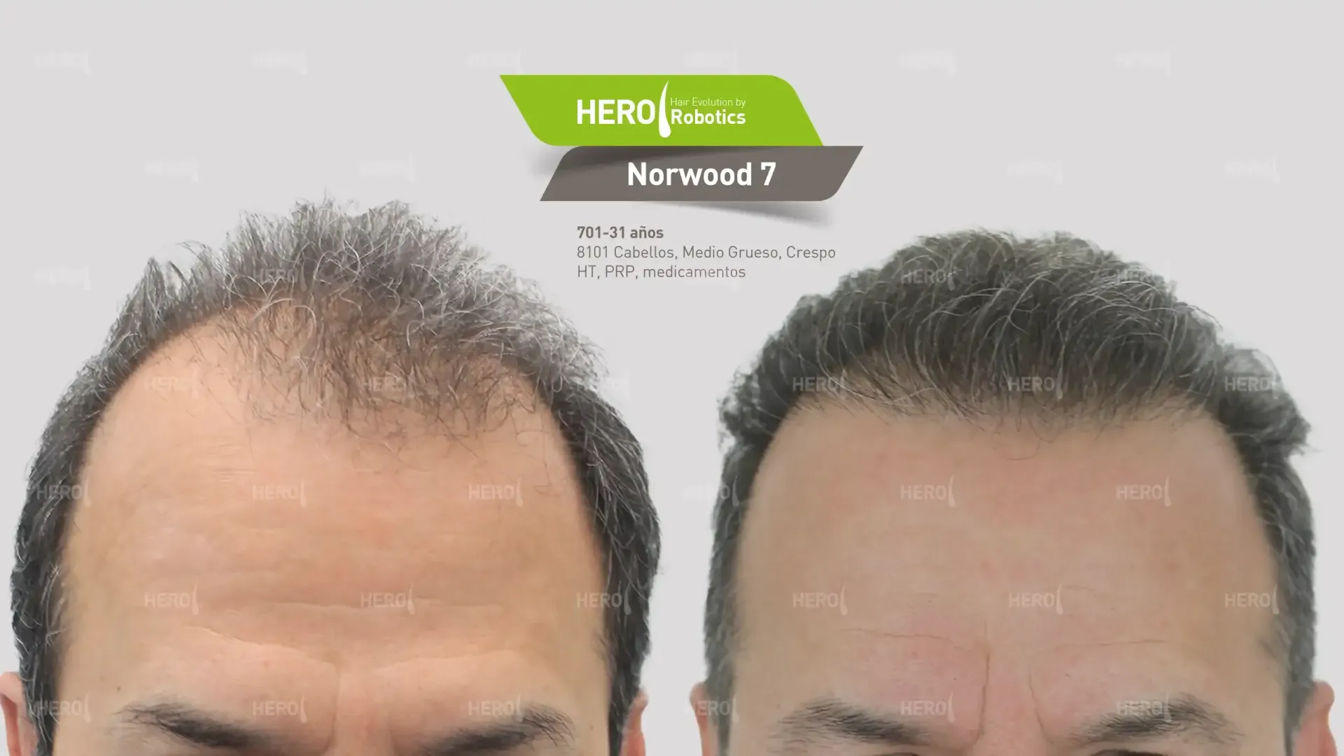 A before and after picture of a man's head with hair loss.  Norwood 7.