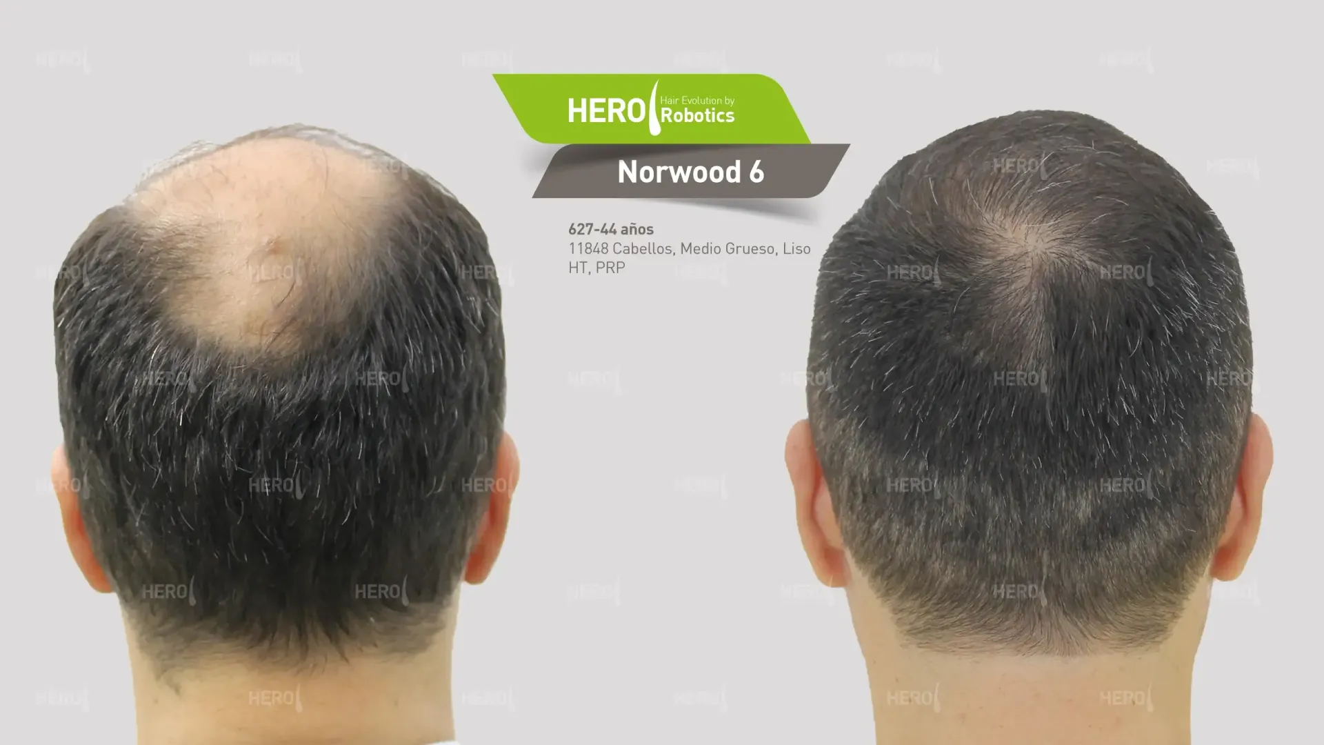 A before and after hair transplant photo of a man 's hair alopecia level Norwood 6