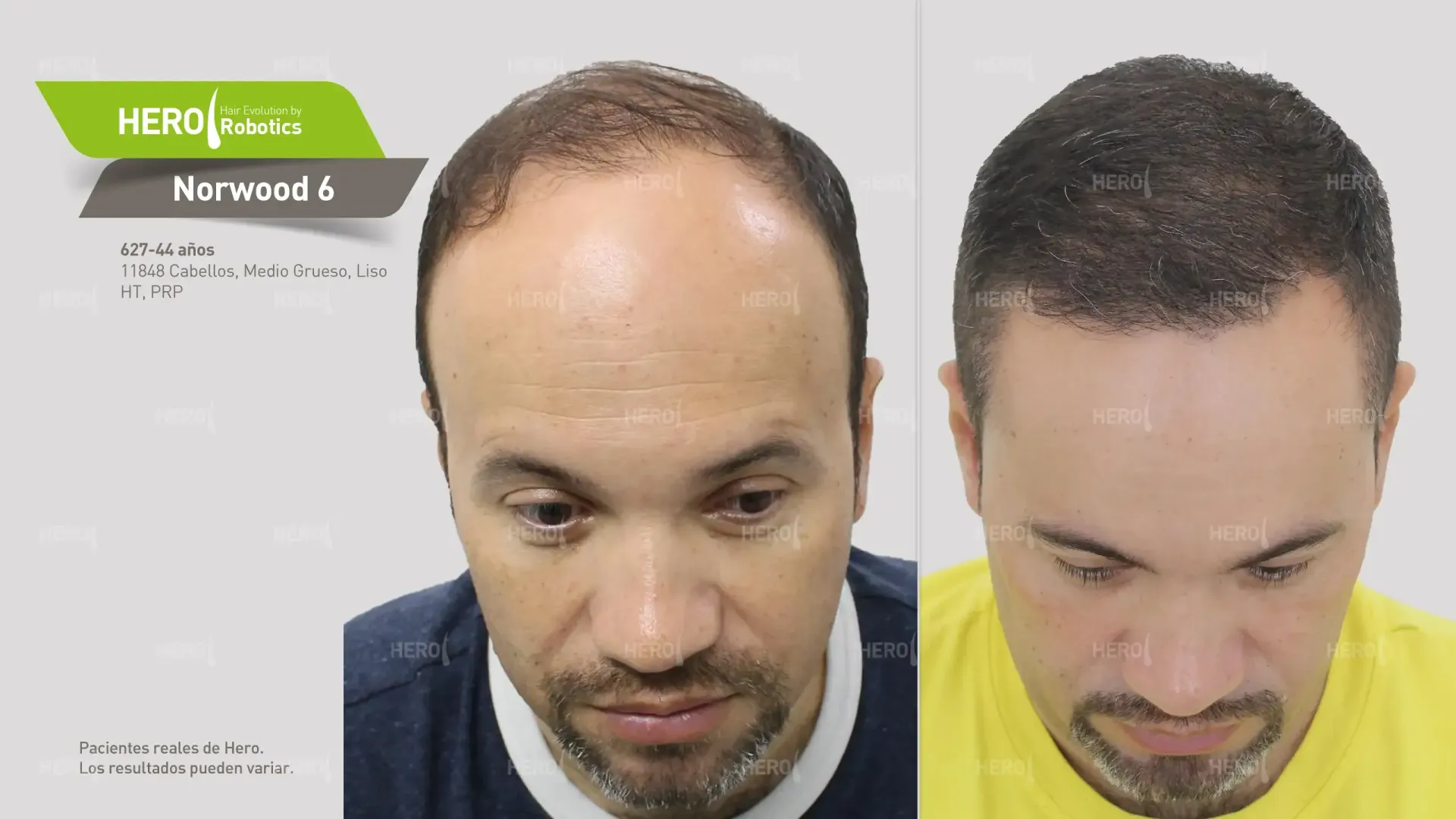 A before and after hair transplant photo of a man 's hair alopecia level Norwood 6