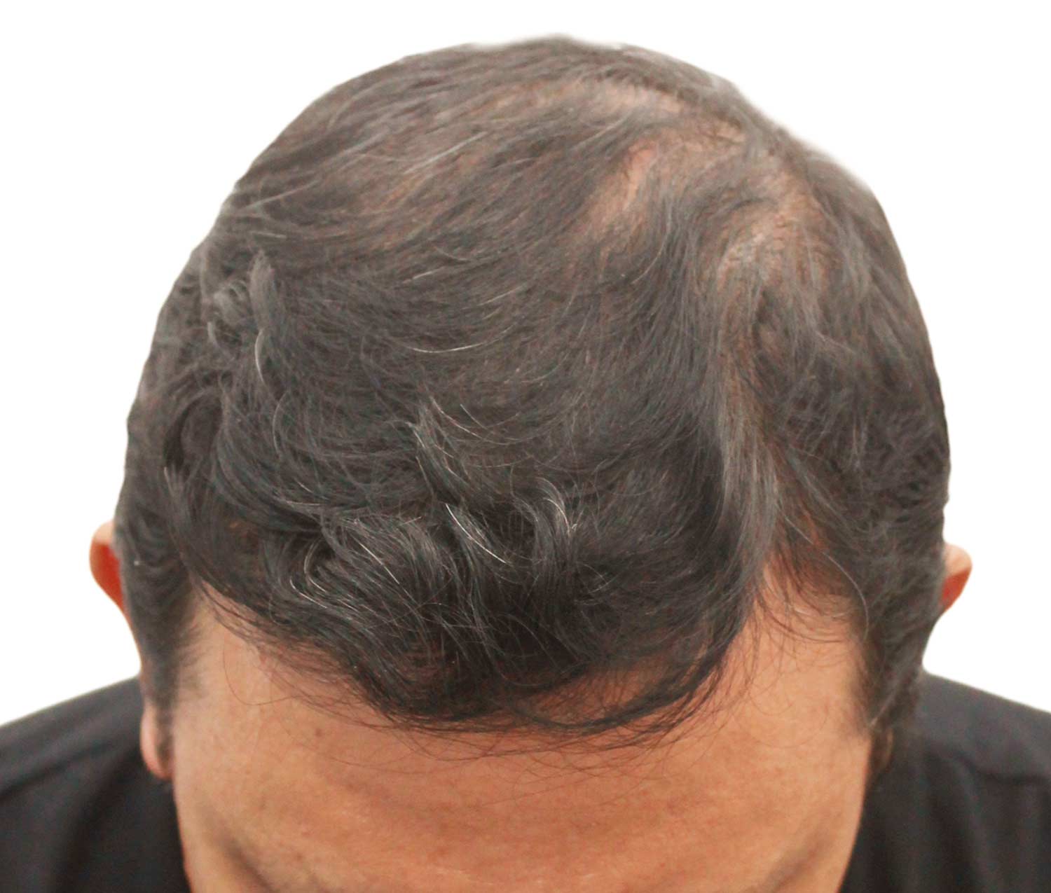 After hair restoration | Real patient, results may vary per individual