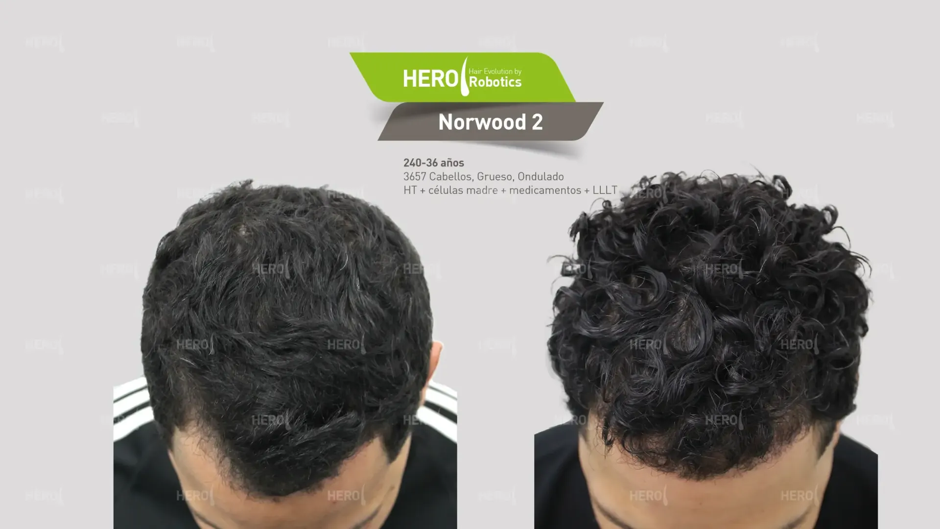 Una foto de antes y después del cabello de un hombre Norwood 2.