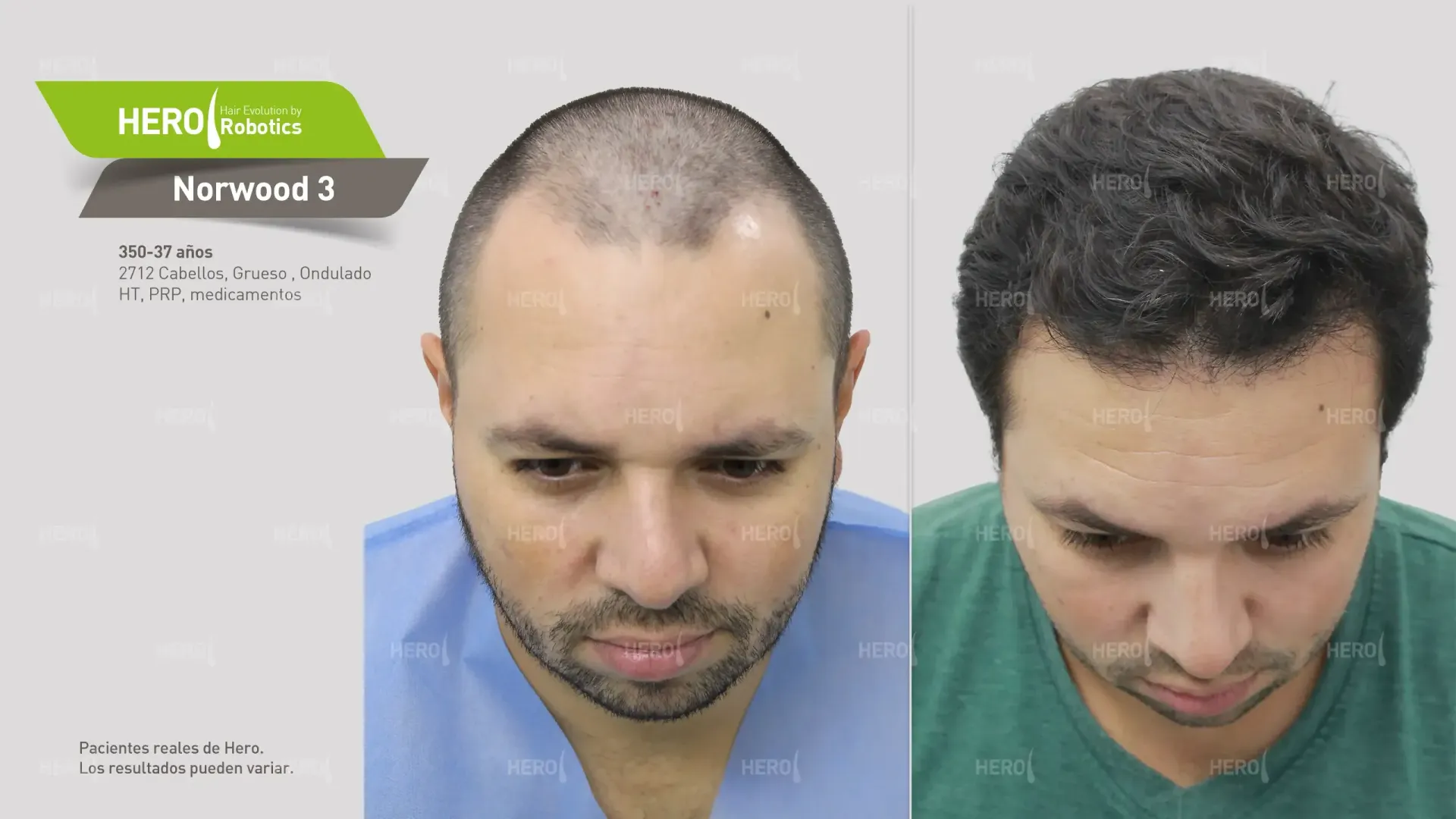 A before and after photo of a man's head Norwood 3