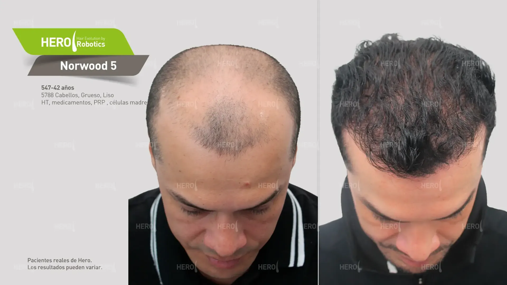A before and after picture of a man 's hair